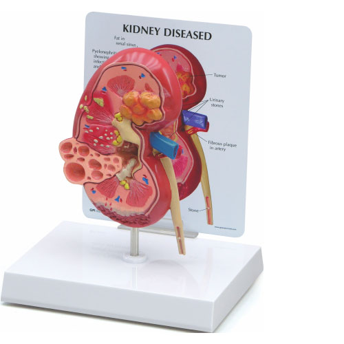 Kidney Cancer Model